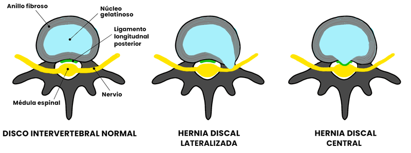 La hernia discal