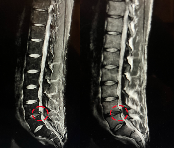 Mi hernia discal Mi hernia discal