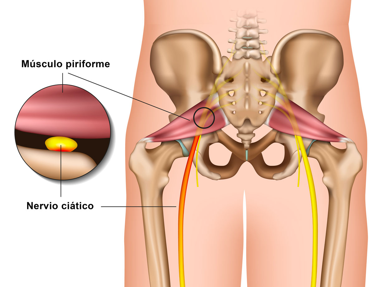 Trayecto del nervio ciático y músculo piriforme Trayecto del nervio ciático y músculo piriforme